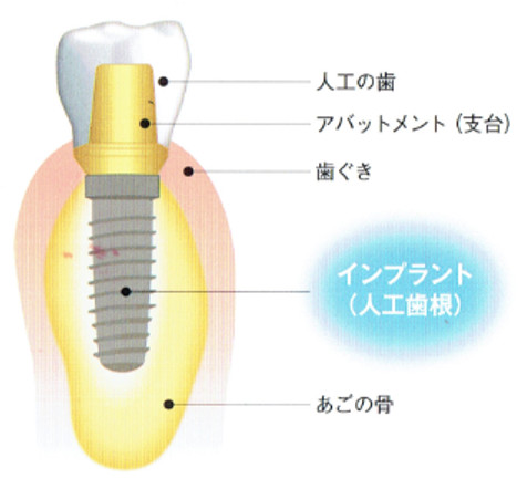 インプラント